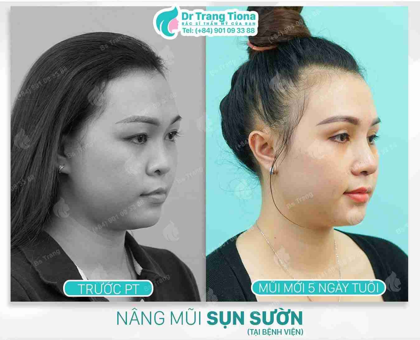 Tổng quan nâng mũi trung bì mỡ và giải đáp từ bác sĩ