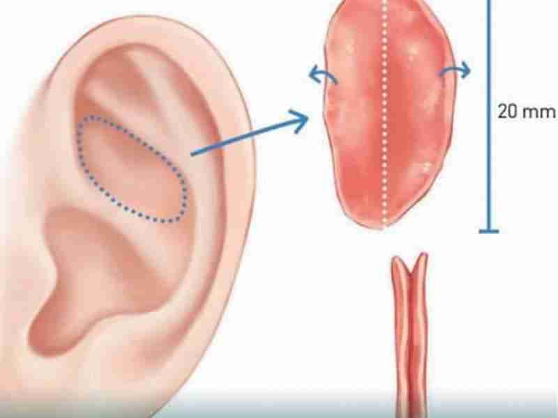 Tổng quan nâng mũi trung bì mỡ và giải đáp từ bác sĩ