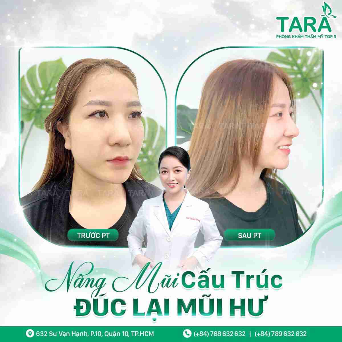 Bác sĩ nâng mũi đẹp uy tín tại TPHCM – Bác sĩ Trang Thẩm mỹ TARA