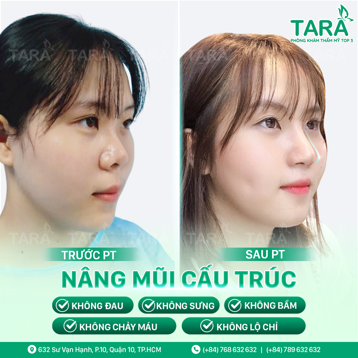 Địa chỉ nâng mũi đẹp uy tín tại TP HCM – Tiến sĩ Bác sĩ Trang Thẩm mỹ TARA – Dr Trang TARA