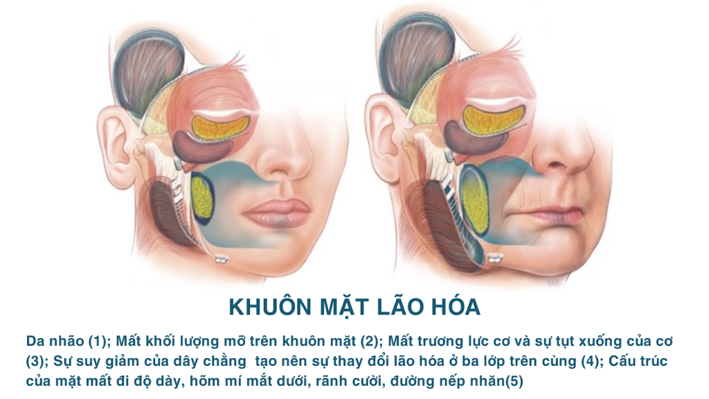 Trên 40 tuổi: nên căng da mặt, căng chỉ hay chỉ tiêm trẻ hóa?