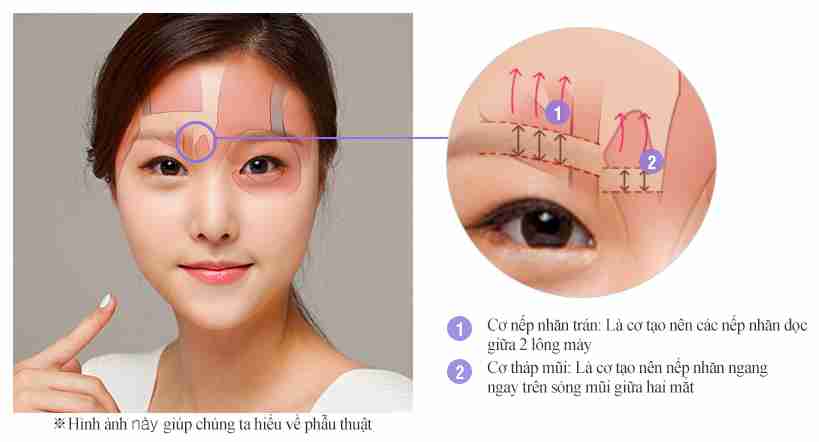 Treo cung chân mày – Giải pháp cho đôi mắt trẻ trung, to tròn