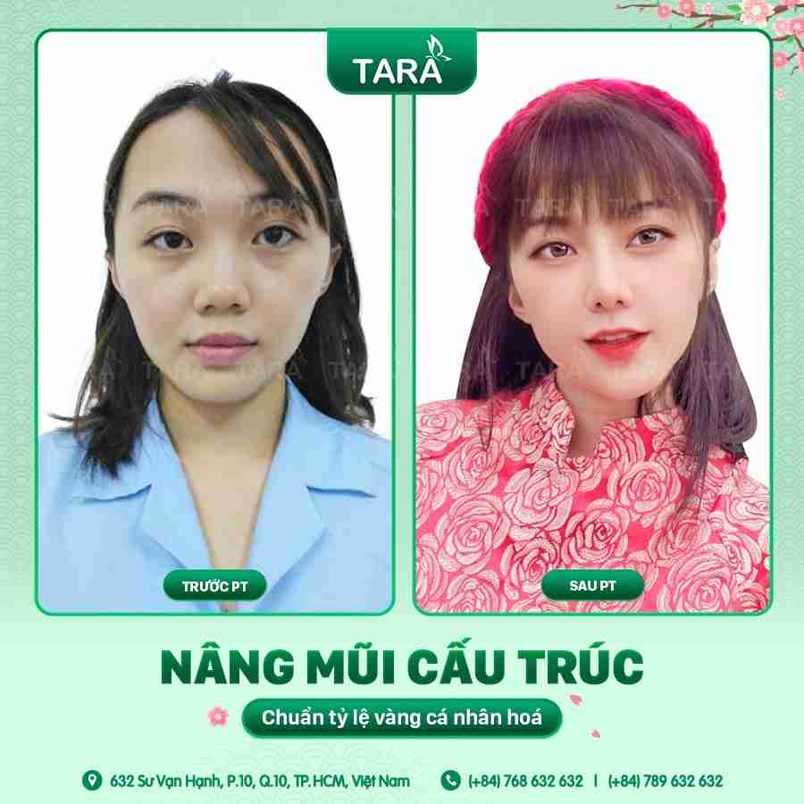 Trụ mũi bị lệch vẹo thì phải làm sao?