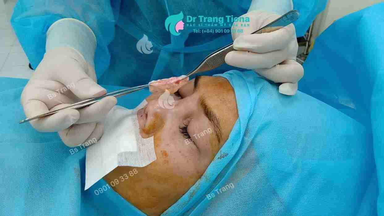 Nhận biết tình trạng tụt sụn mũi sau nâng và giải pháp