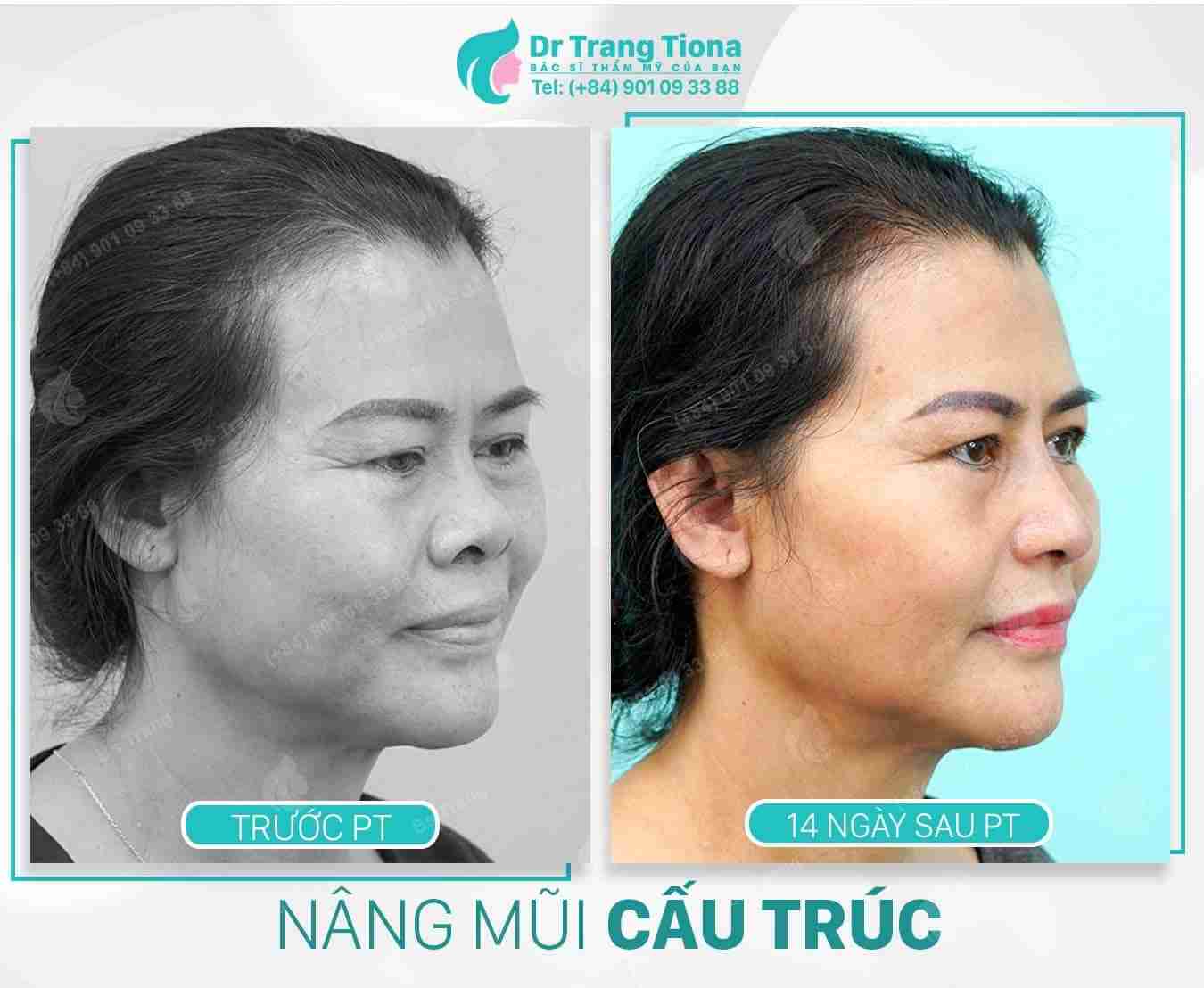 U50 có nên nâng mũi không? Mũi có đẹp không?
