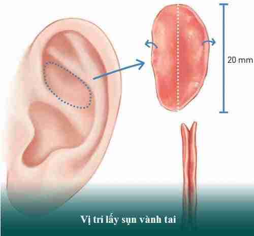 Ưu và nhược điểm của các loại sụn tự thân trong nâng mũi