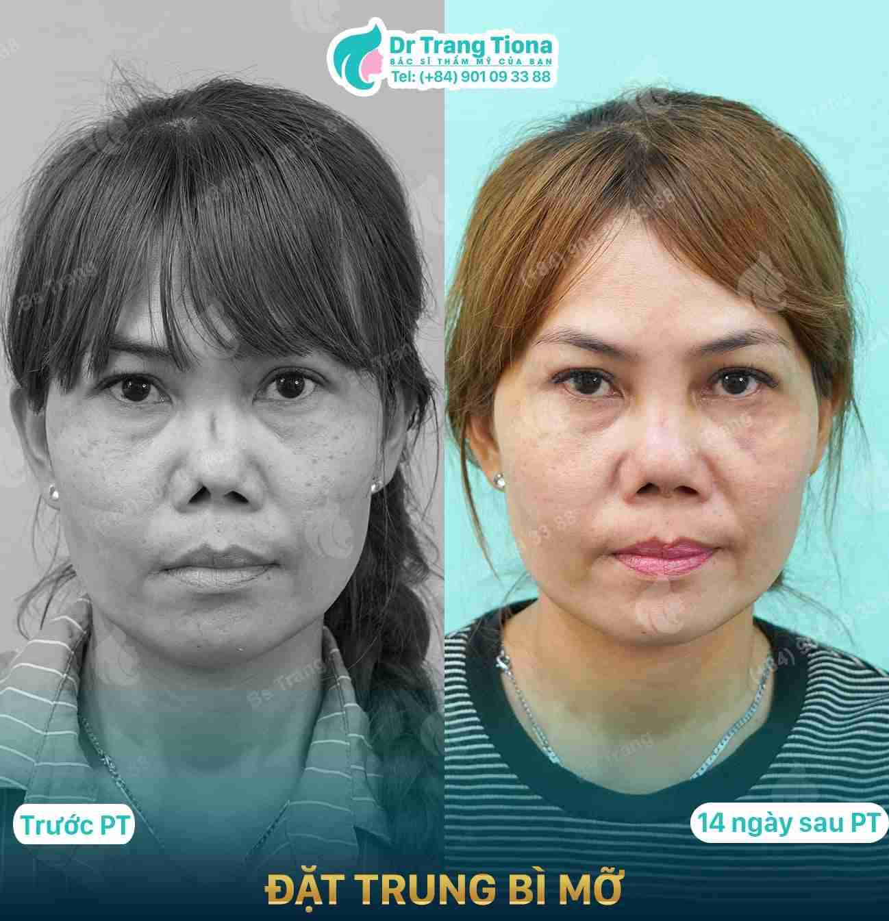 6 ưu và nhược điểm của nâng mũi trung bì mỡ