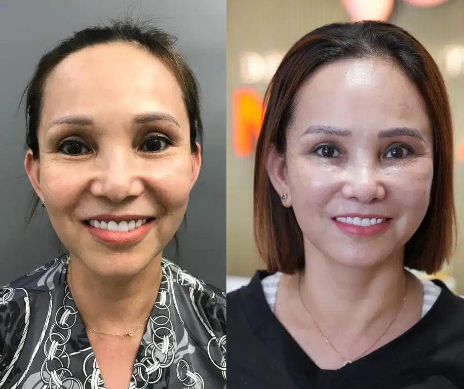 Vừa nâng mũi siêu vi phẫu vừa cấy mỡ mặt, có được không?