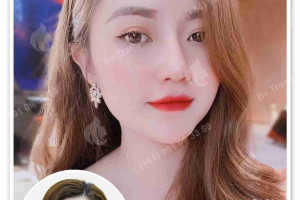 Nâng Mũi Đặt Sống