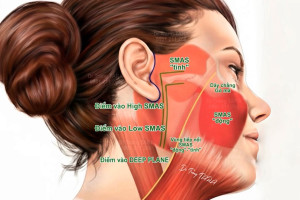 Căng Da Mặt Có An Toàn Không? Ai Nên Phẫu Thuật Căng Da Mặt