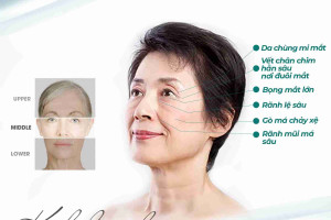 Căng da MIDFACE có tốt không? Có an toàn không?
