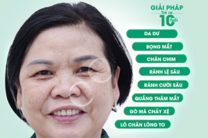 Căng da MIDFACE – Phẫu thuật trẻ hoá tầng mặt giữa ít xâm lấn hiệu qủa nhất hiện nay