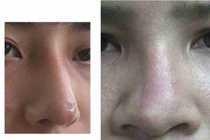 4 dấu hiệu mũi không hợp sụn và cách xử lý