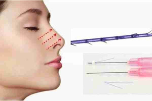 Nâng mũi bằng chỉ và những điều bạn cần biết!