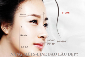 Nâng mũi S-Line bao lâu thì đẹp