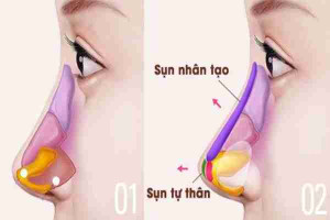 Nên nâng mũi bằng sụn tự thân hay sụn nhân tạo?