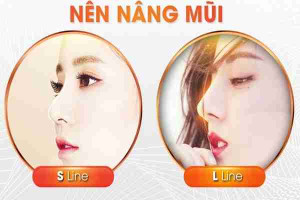 Nâng mũi L-line hay S-line đẹp?