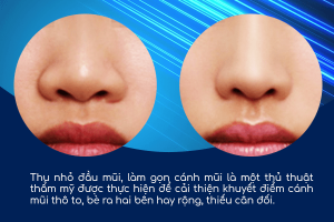 Phẫu thuật thu gọn cánh mũi đầu mũi