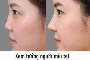 Mũi tẹt là gì? Phương pháp khắc phục mũi tẹt.