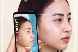 Nâng mũi sống Surgiform là gì? Nâng mũi sống Surgiform có tốt không?