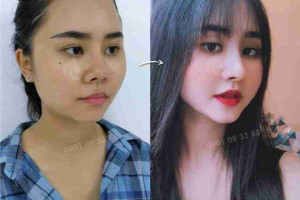 Sự thật về nâng mũi có thay đổi vận mệnh?