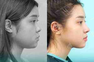 Tại sao lại bị mụn sau nâng mũi? Có nguy hiểm không?