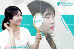 Giải đáp từ A-Z thế nào là quy trình nâng mũi đạt chuẩn