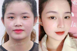 Mũi đầu to và cách khắc phục mũi đầu to để có dáng mũi cao như ý