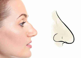 Mũi diều hâu hay mũi két là gì? Có nên sửa hay không?