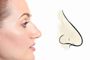 Mũi diều hâu hay mũi két là gì? Có nên sửa hay không?