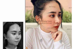 Mũi tẹt ảnh hưởng thế nào đến đời sống và tình cảm?