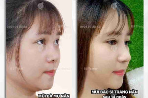 Đi tìm cách khắc phục sống mũi gãy hiệu quả 