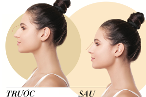 Tiêm filler mũi và những sự thật bạn cần biết rõ