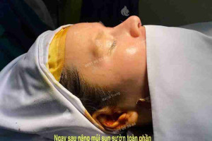 Bác sĩ giải đáp: Nâng mũi sụn sườn có bị teo lại không?