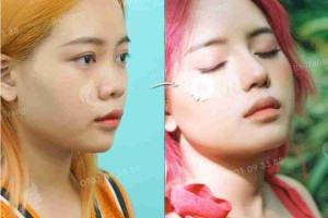 Gợi ý 6 cách làm mũi cao phổ biến hiện nay