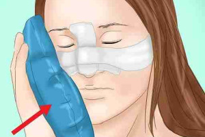 Cách chườm đá sau khi nâng mũi đúng chuẩn