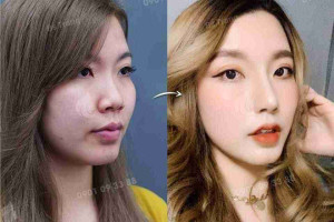 5 cách giảm sưng sau nâng mũi giúp hồi phục nhanh   