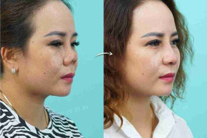 Nguyên nhân đầu mũi bị đỏ sau nâng mũi và cách xử lý