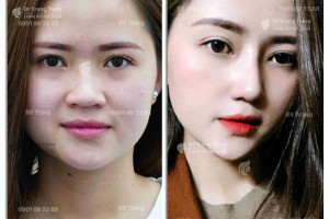 Bật mí 7 bí quyết để nâng mũi cấu trúc Surgiform đẹp