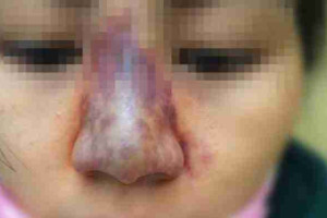 4 biến chứng khi tiêm filler mũi và cách phòng tránh