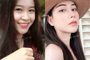 Cảm giác sau khi nâng mũi như nào? Khó chịu không? 