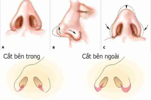Hiểu rõ về phương pháp cuộn cánh mũi và cắt cánh mũi