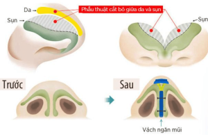 Giải đáp từ A-Z về nâng mũi bán cấu trúc dựng trụ  