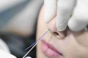 Nâng mũi bằng chỉ collagen hiệu quả như thế nào?