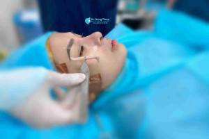 Nâng mũi cấu trúc có thật sự an toàn?