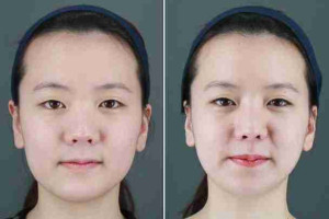 Cấy mỡ mặt Baby Face có hiệu quả lâu dài không?