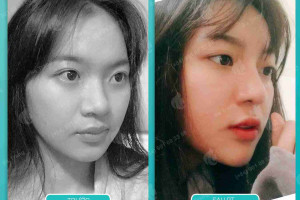 Nâng mũi cấu trúc là gì? Liệu có tốt để bạn sửa mũi?