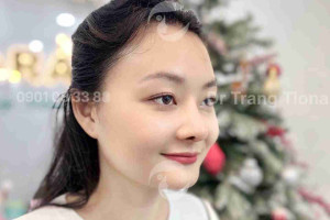 Review nâng mũi sụn sườn: Không phải ai cũng phù hợp