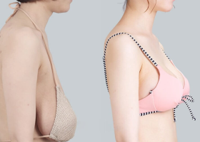 Treo ngực sa trễ là gì – Giải đáp từ bác sĩ phẫu thuật