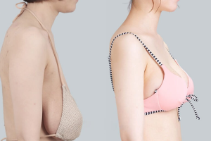 Treo ngực sa trễ là gì – Giải đáp từ bác sĩ phẫu thuật